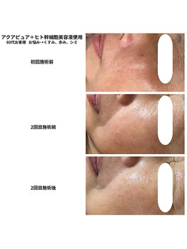 リノア(Linoa)/ヒト幹細胞美容液ケア