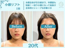 フローフシ∞/【小顔】切らない小顔リフト