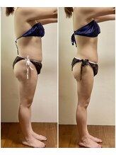 ニコワ(Nicowa)/Nicowaの痩身★BeforeAfter