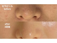 セラピールで黒ずみ毛穴ケア！うるおい艶肌へ