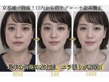 サロンチオリ 烏丸(Salon Chiori)/口角、目の左右差、エラ張り矯正