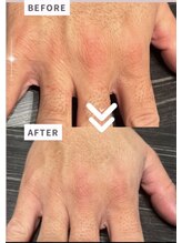 インフィニティ(INFINITY)/メンズ脱毛