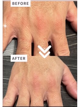 インフィニティ(INFINITY)/メンズ脱毛