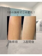 トッコ 清澄白河店(tocco)/キッズも脱毛できます