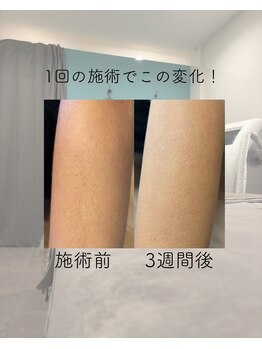 トッコ 清澄白河店(tocco)/キッズも脱毛できます
