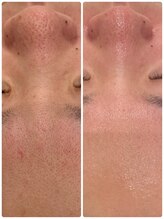 ローゼ(ROSE)/【毛穴洗浄】【フェイシャル】