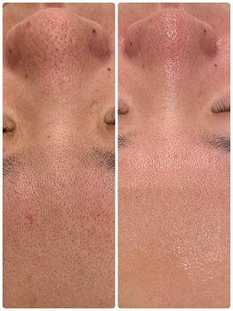 ローゼ(ROSE)/【毛穴洗浄】【フェイシャル】