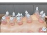 【背中の疲れもハミ肉も】筋膜カッピング×深層ラジオ波背中