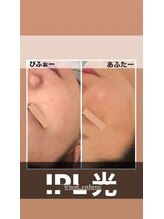 ノフ 恵比寿(noff)/光フェイシャル×美容鍼