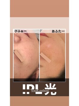 ノフ 恵比寿(noff)/光フェイシャル×美容鍼