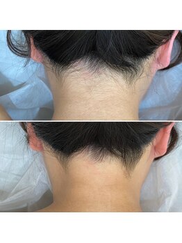 インベスト(INVEST)/うなじ脱毛