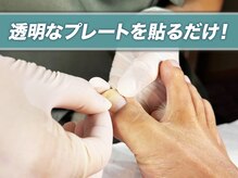 巻き爪研究所 表参道院/プレートを貼るだけの簡単な施術