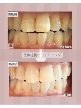 ハチ(HACHI)/医療提携ホワイトニング