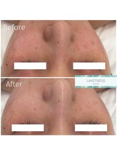 クレア(Clair)/アンストレス症例