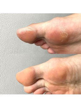 アオドットネイル(Ao. Nail)の写真/【西新宿/都庁前駅5分】年齢を重ねるごとに気になる踵のガサガサや巻き爪等のトラブルケアもお任せ♪