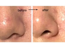 鼻の毛穴スッキリ！
