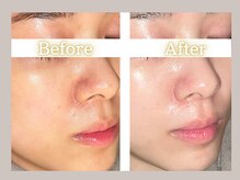 ハル(HARU.)/たった1度で肌が変わる