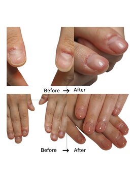 ネイルサロン ボニール(BONIR)の写真/爪の形、長さにコンプレックスがある方へ。深爪緩和コースで手元に自信を！割れやすい等のお悩みにも◎