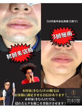 キムラケ(KIMURAKE)/たったの3回でツルン!