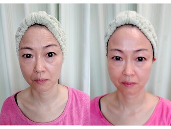 ソフィーム/エンビロンリフトフェイシャル