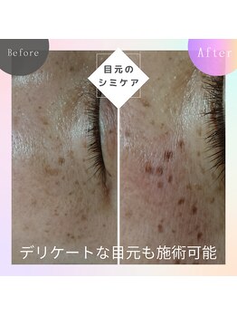 ロコモ 美容矯正サロン(Locomo)/目の下も施術可能です：シミケア