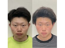 小顔22 ボルティ 赤坂支店(Bolty)/10代学生：悩み【頬の出っ張り】