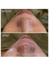 ビューティーモール(BEAUTY MALL)/ヒト幹細胞水光導入エステ