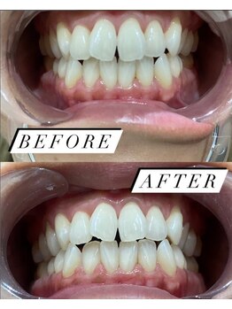 ヘーラー(Hera)/【施術例】セルフホワイトニング