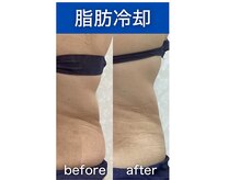 シアラ(SHIARA)/脂肪冷却１回の変化