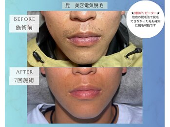 ハエン(HAEN)/髭 マイクロニードル脱毛