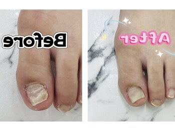 ビジューネイルズ 西川口店(bijou nails)の写真/フット&ハンド同時可能 【ダメージ爪・二枚爪・表面の凹凸が気になる方へ】フット補強1本750円