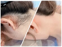 フェザー(feather)/WAX脱毛