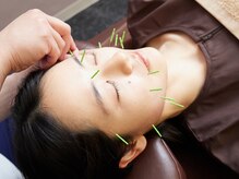 オリガミ鍼灸接骨院 旭丘院/オーダーメイド美容鍼