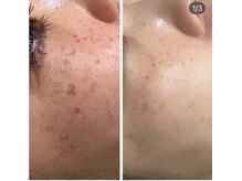 ラヴィエール(Laviere)/シミ緩和＋プラズマシャワー