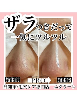 エクラーレ(Eclale)/【毛穴ケア】症例