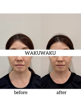 ワクワクフェイス 横浜店(WAKUWAKU FACE)/韓国小顔コルギ×肩甲骨×リンパ