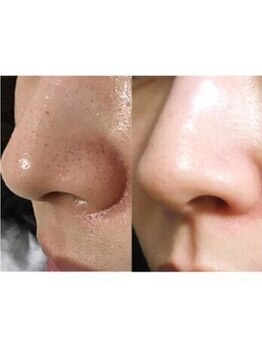 ブプラ 光の森店(BUPURA)/ビフォーアフター