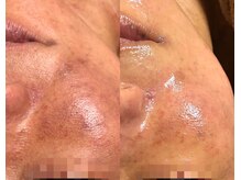 アルジェンヌ 五井店/ACトリートメントヒト幹細胞導入