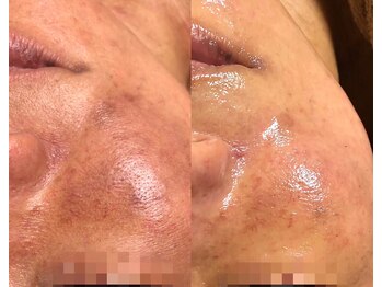 アルジェンヌ 五井店/ACトリートメントヒト幹細胞導入