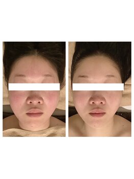 小顔になりたい