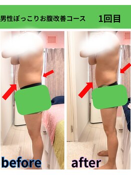 リラ(Lilas)/【痩身】ぽっこりお腹改善 1回目