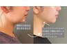 【都内で大人気！】プラズマリフトアップコース～小顔になりたい方へ～　30分