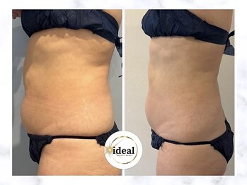 アイディール(ideal)/脂肪減少10ミリ