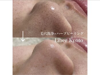 エステティック リベル キョウト 京都駅前店(Esthetic Liber Kyoto)/毛穴洗浄×ハーブピーリング