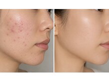 スパエスター 銀座本店(SPA Esther)/ビフォーアフター