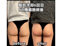 ソライロの雰囲気（脂肪冷却のビフォーアフターです♪　）