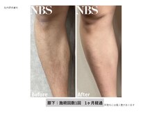 キャンアイドレッシー 東鷲宮店/初回メンズ　両足全体脱毛