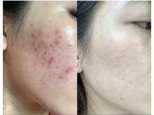 ヴィオール 名古屋栄店(VIOR)/ハーブピーリング