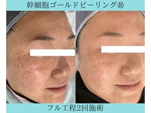 リメイククリニカルビューティー(Remake clinical beauty)/若い頃に沢山日焼けされた方も