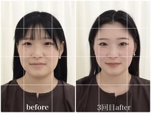 アキュモンド 渋谷院(acumond)/acumondコース初回と3回目の変化